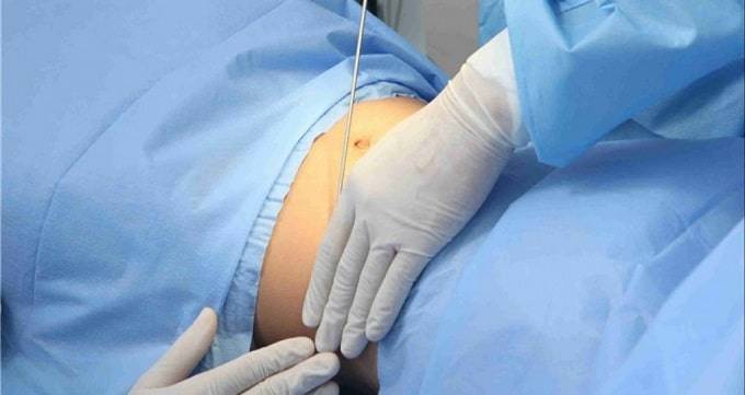 مراقبت های بعد از جراحی لیپوماتیک